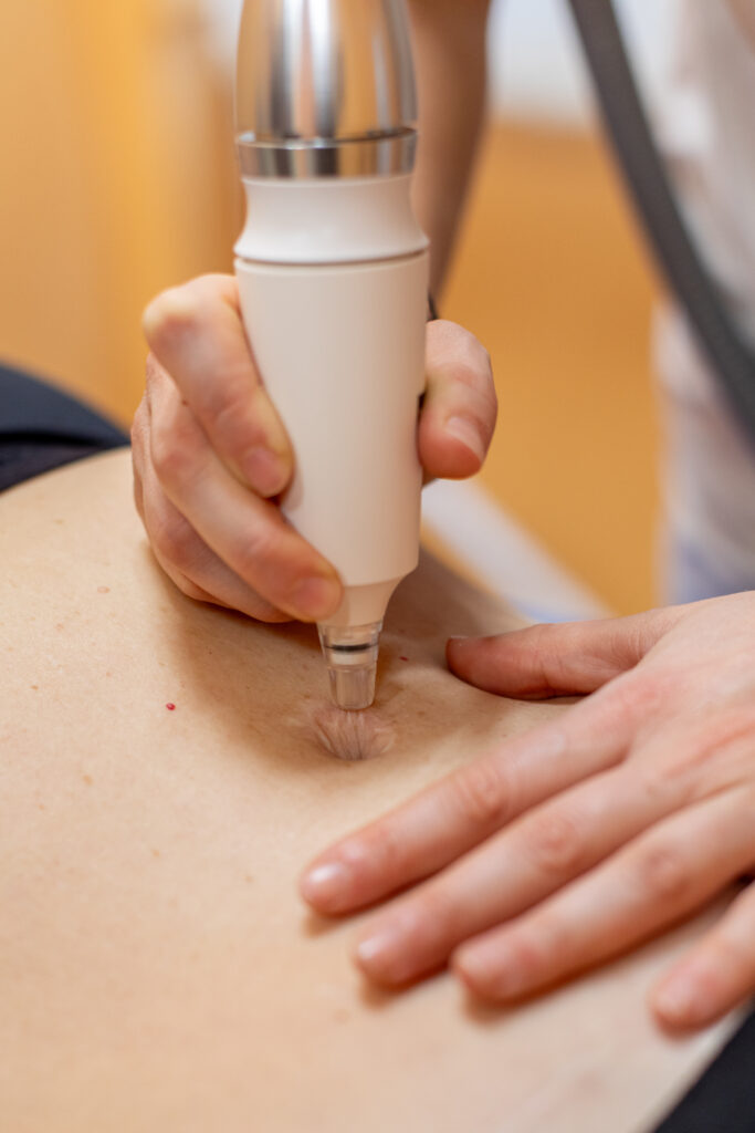 fisioterapista tratta cicatrice con lpg medical