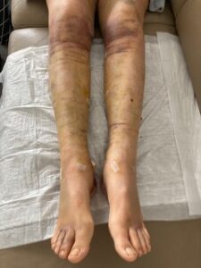 Fisioterapia per il trattamento chirurgico del lipedema